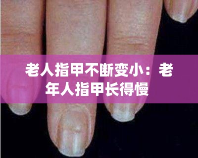 老人指甲不断变小：老年人指甲长得慢 