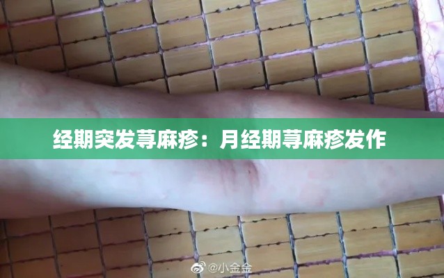 经期突发荨麻疹：月经期荨麻疹发作 