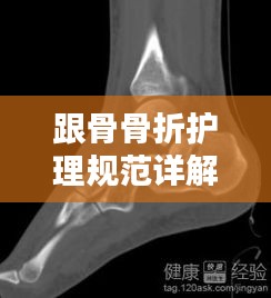 跟骨骨折护理规范详解