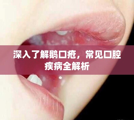 深入了解鹅口疮，常见口腔疾病全解析