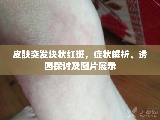 皮肤突发块状红斑，症状解析、诱因探讨及图片展示